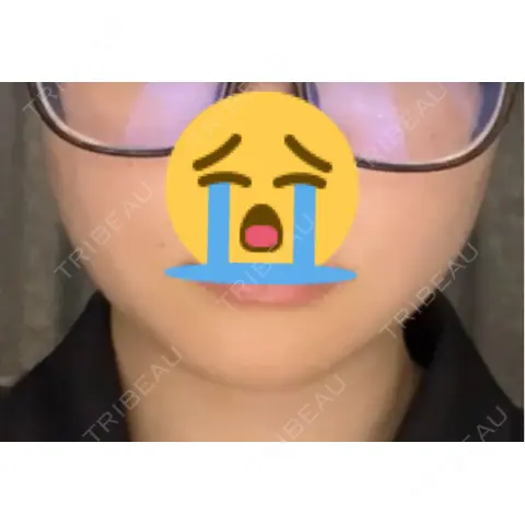 脂肪吸引注射（顔） MIL CLINIC OSAKA AFTER