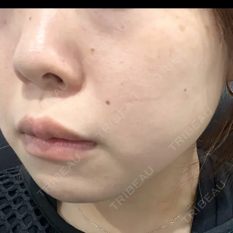 エレクトロポレーション / ルメッカ B-LINE CLINIC 池袋院 AFTER