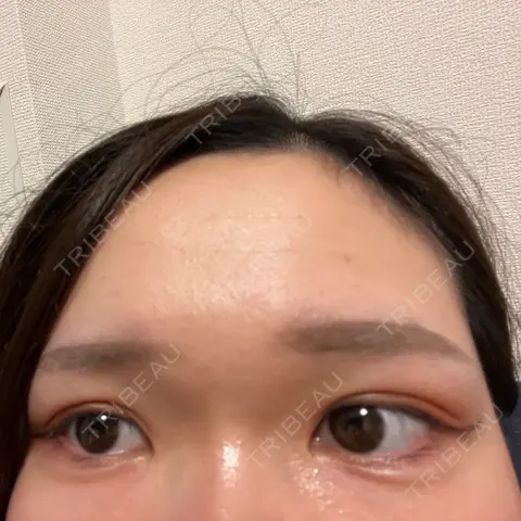 ヒアルロン酸注入（涙袋） NARU Beauty Clinic 【ナルクリ】 BEFORE