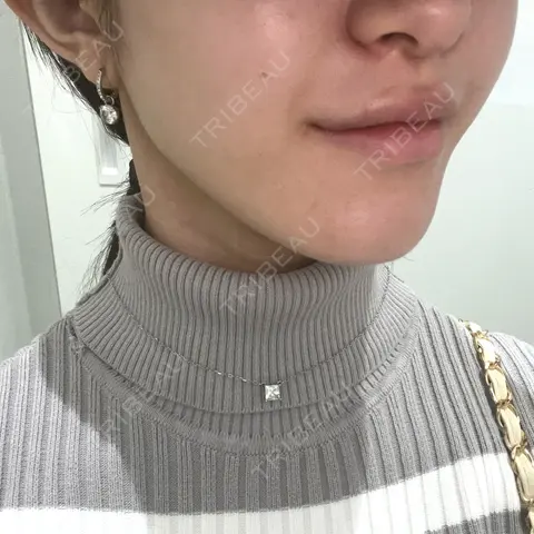 ヒアルロン酸注入（唇） R Beauty CLINIC 銀座院 BEFORE