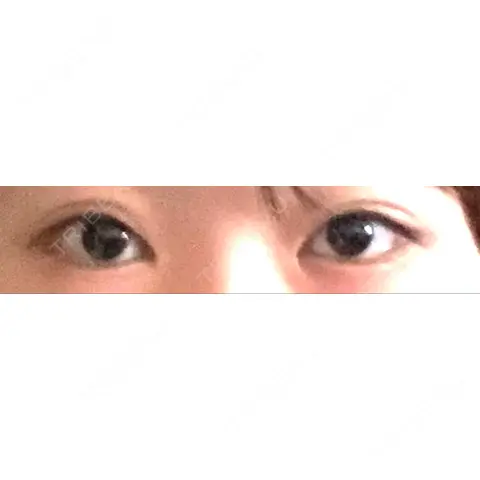 目頭切開 / 眼瞼下垂（切開） / 目尻切開 / タレ目形成・グラマラスライン（切開） / 目元修正 / 目尻靭帯移動 DIVINE（ディバイン）整形外科 AFTER