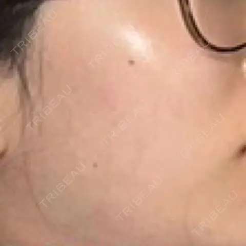 その他（肌） 美容皮膚科 デュークリニック AFTER