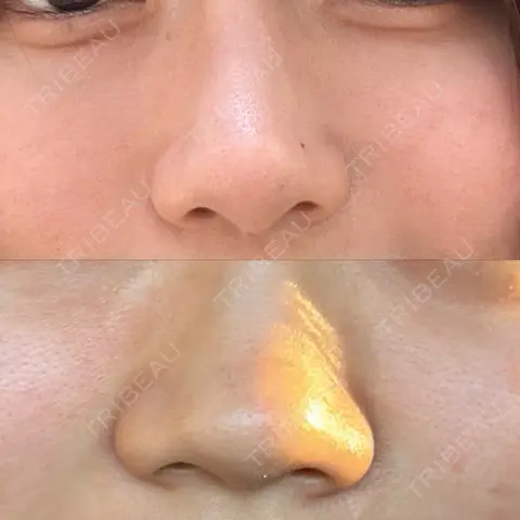 鼻尖形成（切開） / 軟骨移植 / ワシ鼻修正・ハンプ切除 / 鼻柱下降・鼻唇角形成（猫手術） / その他（鼻） 東京シンデレラ美容外科 新宿院 AFTER