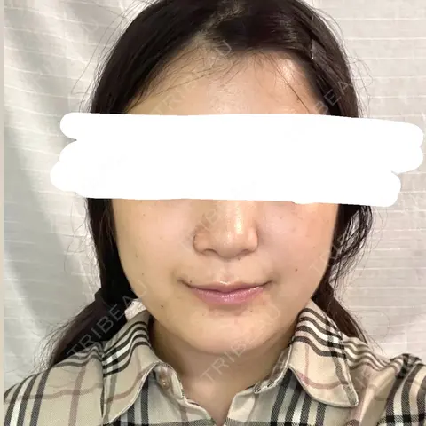 ヒアルロン酸注入（鼻翼基部） AI Beauty Clinic （エーアイ美容クリニック） BEFORE