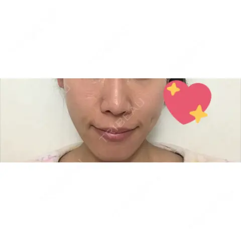 糸リフト DAILY SKIN CLINIC 心斎橋院 AFTER