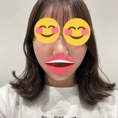 メーラーファット除去 R Beauty CLINIC 大阪院 BEFORE