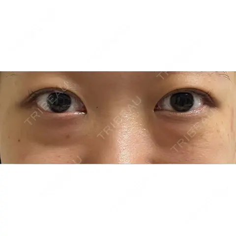 下まぶたの脂肪取り APOLLO BEAUTY CLINIC AFTER