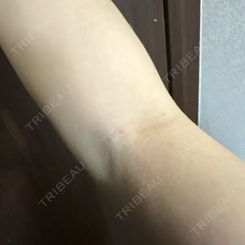 美容点滴・美容注射（美肌） / 白玉点滴・注射 新宿美容内科医療クリニック AFTER