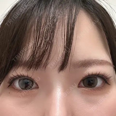 ヒアルロン酸注入（涙袋） NARU Beauty Clinic 【ナルクリ】 BEFORE