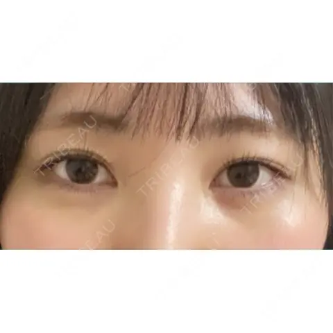 ボトックス（タレ目） 湘南美容クリニック 金山院 AFTER