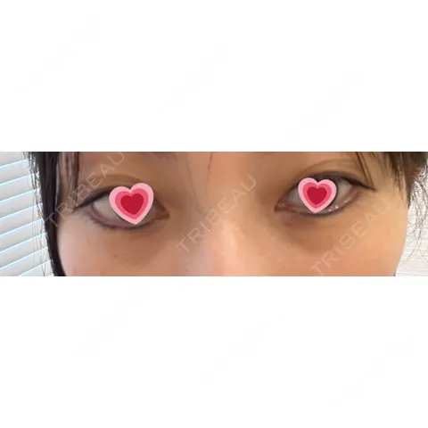 下まぶたの脂肪取り / その他 東京美容医療クリニック 池袋院 AFTER