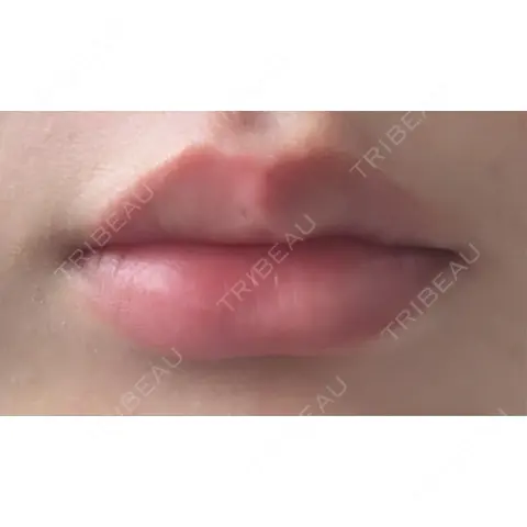 その他（口元） R Beauty CLINIC 銀座院 AFTER