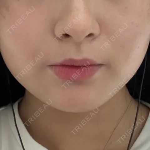ボトックス（エラ・小顔） DMTC美容皮膚科 渋谷院 AFTER