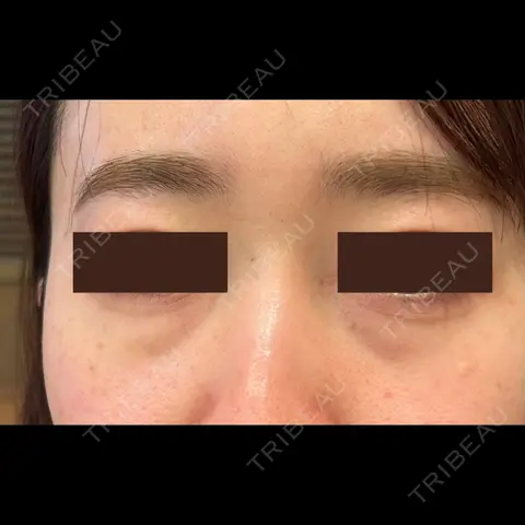 クマ治療 / 下まぶたたるみ取り / 下まぶたの脂肪取り APOLLO BEAUTY CLINIC AFTER
