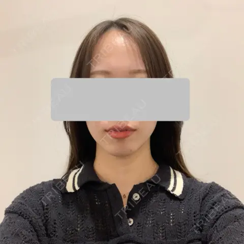 ヒアルロン酸注入（あご） HAAB×DREAM BEAUTY CLINIC 東京本院 AFTER