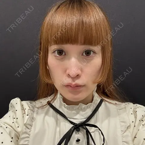 スレッドノーズ YBC横浜美容外科 立川院 AFTER
