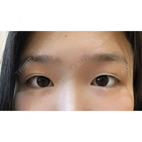二重切開 / クマ治療 R Beauty CLINIC 銀座院 AFTER