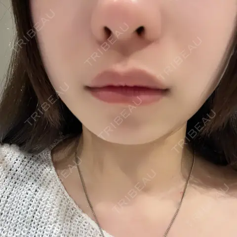 ヒアルロン酸注入（唇） R Beauty CLINIC 銀座院 BEFORE