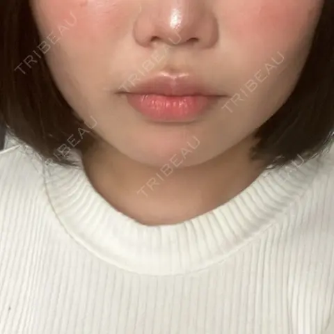 ヒアルロン酸注入（あご） / ボトックス（エラ・小顔） / 脂肪溶解注射（顔） 東京美容外科 池袋院 AFTER