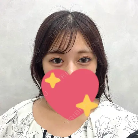 ヒアルロン酸注入（涙袋） YBC横浜美容外科 立川院 AFTER