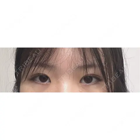 目頭切開 東京美容外科 仙台院 AFTER