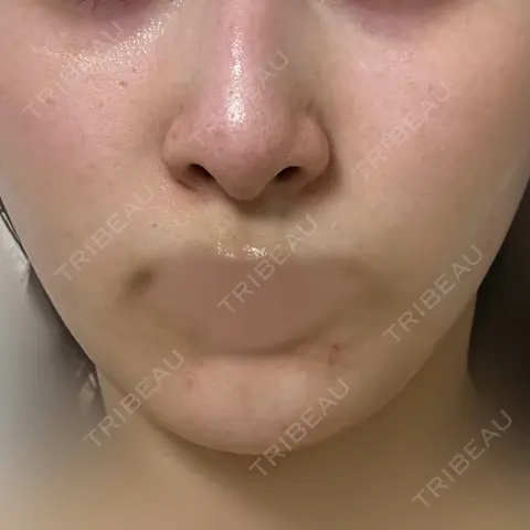 ダーマペン DAILY SKIN CLINIC 心斎橋院 AFTER