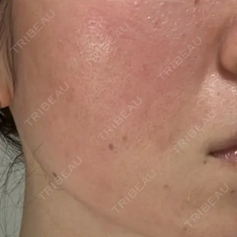 ポテンツァ ARTE SKIN CLINIC 【アルテスキンクリニック】 AFTER