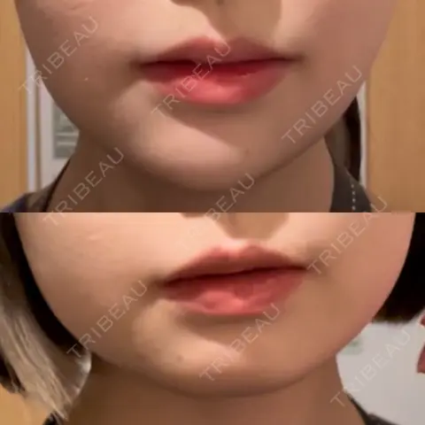 ボトックス（エラ・小顔） KARIS beauty clinic BEFORE