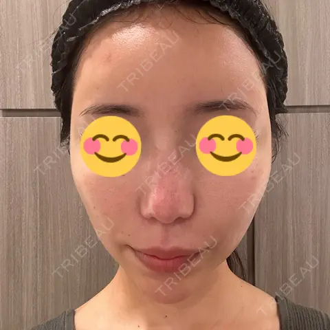 ポテンツァ LUNA BEAUTY CLINIC 池袋駅前院 BEFORE