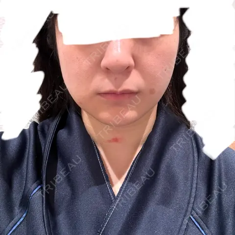 脂肪吸引（顔） Mods Clinic（モッズクリニック） 東京院 AFTER