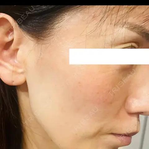 PRP皮膚再生療法 ノリス美容クリニック AFTER