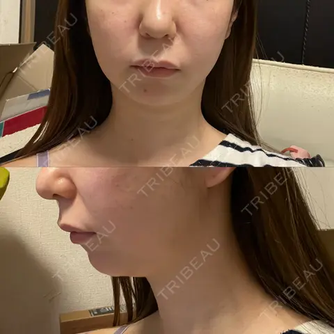糸リフト / 脂肪吸引（顔） RIVER CLINIC（リバークリニック） AFTER