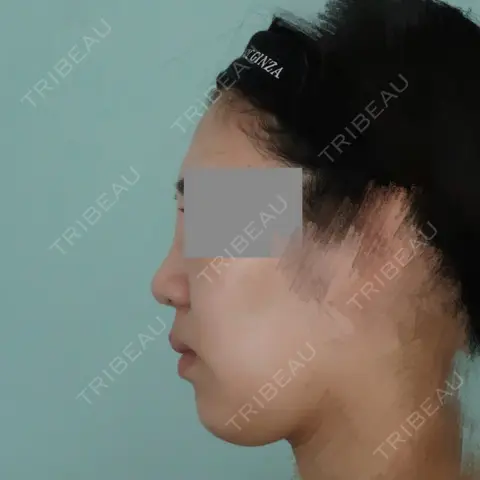 小鼻縮小（切開） / 軟骨移植 / 鼻孔縁挙上 WOM CLINIC GINZA （ワム クリニック ギンザ） AFTER