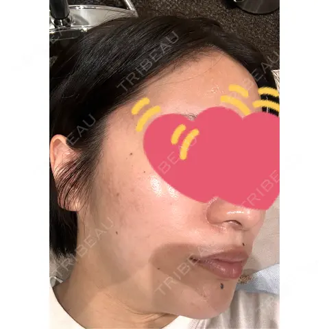 ダーマペン Re:anne clinic 銀座 【リアンクリニック銀座】 AFTER