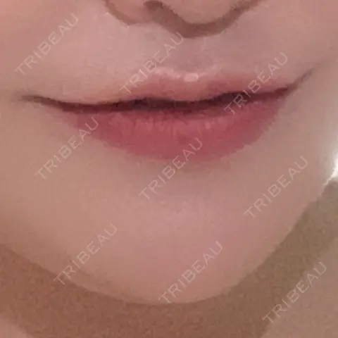 口角挙上 / その他（口元） R Beauty CLINIC 銀座院 AFTER