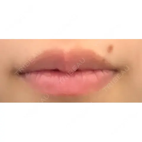 ヒアルロン酸注入（唇） / ボトックス（口角） R Beauty CLINIC 銀座院 AFTER