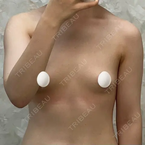 豊胸（脂肪注入） R Beauty CLINIC 銀座院 AFTER