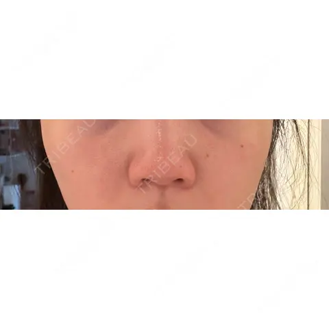 鼻尖形成（切開） / 軟骨移植 / 鼻柱下降・鼻唇角形成（猫手術） グローバルビューティークリニック 銀座院 AFTER