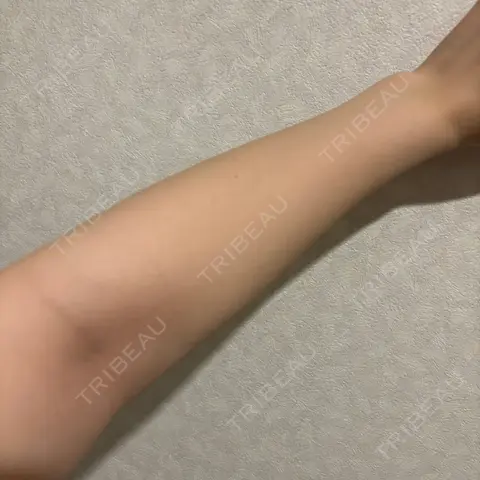 美容点滴・美容注射（美肌） MYCLINIC 西新宿 AFTER