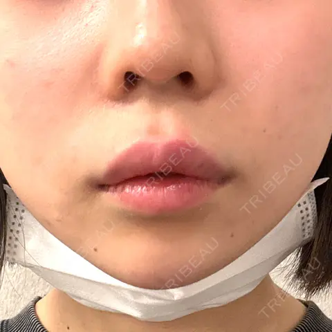 ボトックス（あご） / ボトックス（口角） / ボトックス（タレ目） / ボトックス（人中） / ボトックス（ガミースマイル） / ヒアルロン酸注入（鼻翼基部） BiBiクリニック AFTER