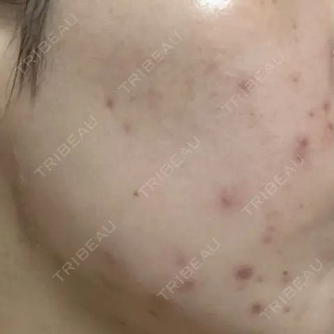 ニードルRF（ポテンツァなど） ARTE SKIN CLINIC 【アルテスキンクリニック】 AFTER