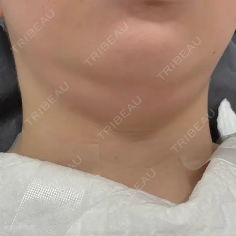 糸リフト / 脂肪吸引（顔） / 脂肪吸引注射（顔） ziz CLINIC AFTER