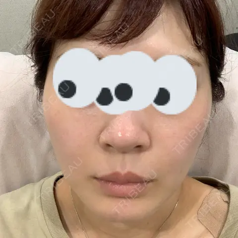 美容点滴・美容注射（ダイエット） / 美容点滴・美容注射（疲労回復） / ピコレーザートーニング（美白・肝斑） / ピーリング（ハリ・ツヤ） / ピコフラクショナルレーザー（毛穴・ニキビ跡） 表参道メディカルクリニック 大阪院 AFTER