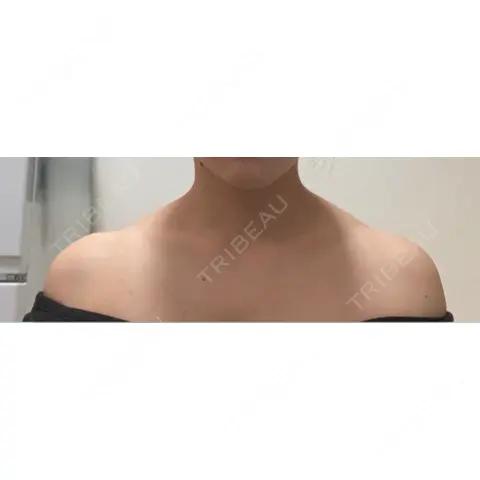 ボトックス（肩） 日比谷セントラルクリニック AFTER