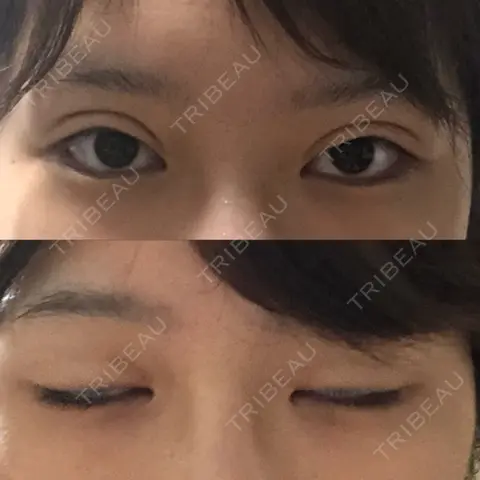 眼瞼下垂（切開） 大阪TAクリニック AFTER