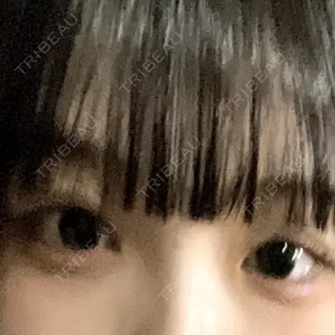 目頭切開 吉祥寺アイビークリニック AFTER