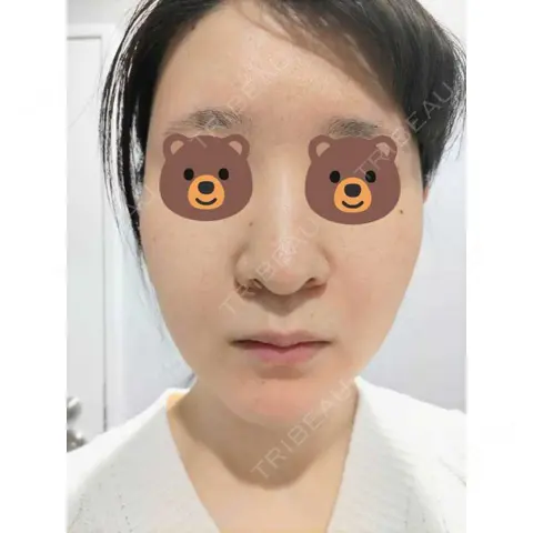 ヴェルヴェットスキン ブリリアスキンクリニック AFTER
