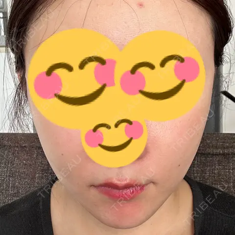 脂肪溶解注射（顔） あいち栄クリニック AFTER