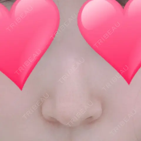 小鼻縮小（切開） プラストクリニック AFTER