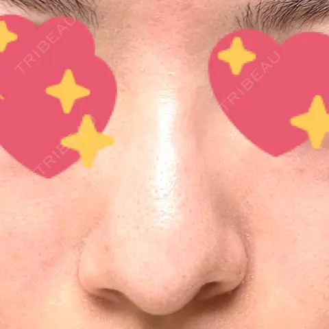 鼻尖形成（切開） / 軟骨移植 / 骨切幅寄せ / プロテーゼ除去 9BeautyClinic AFTER